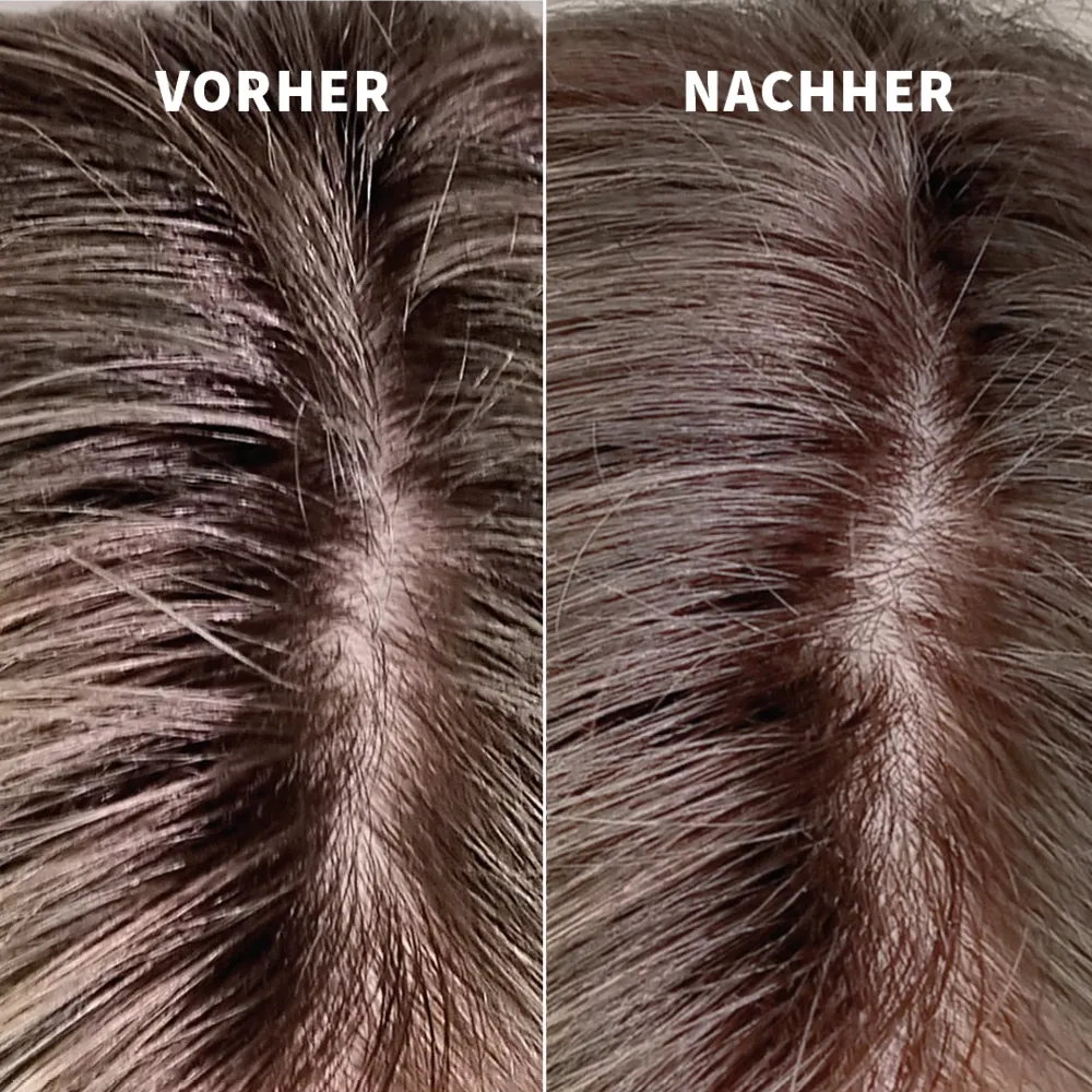 Vorher-Nachher-Ergebnis mit PUR HAIR Dry Foam Shampoo – fettiger Haaransatz wird sichtbar erfrischt und wirkt nach der Anwendung sauber, leicht und gepflegt
